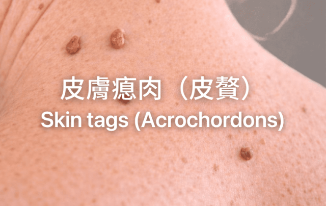 Skin tags (Acrochordons) 皮膚瘜肉（皮贅）